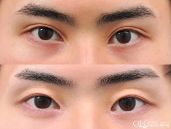 Before/After