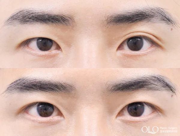 Before/After