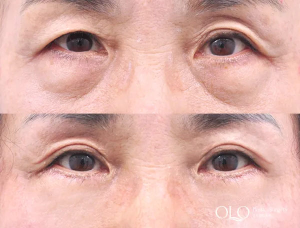 Before/After