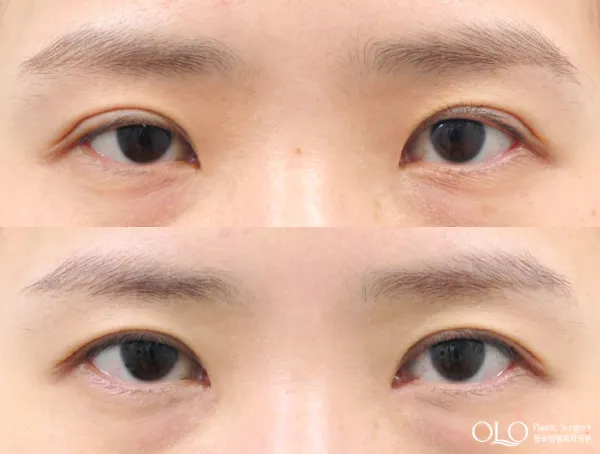 Before