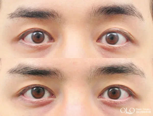 Before/After