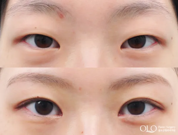 Before/After