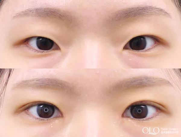 Before/After