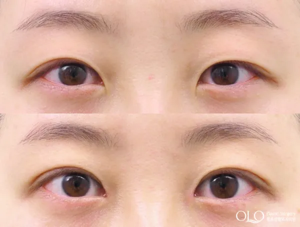 Before/After