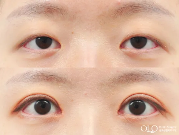 Before/After