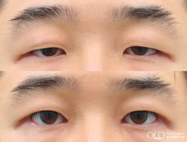 Before/After