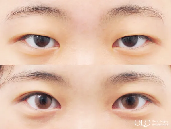 Before/After