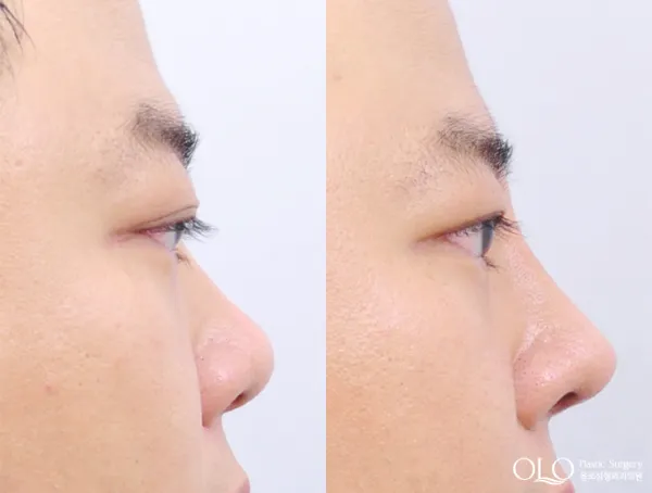 Before/After