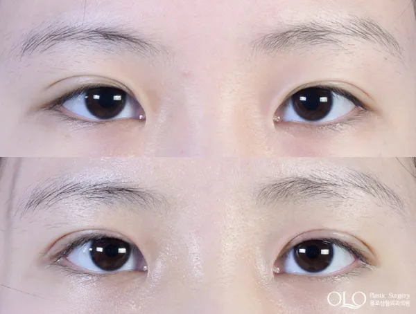 Before/After