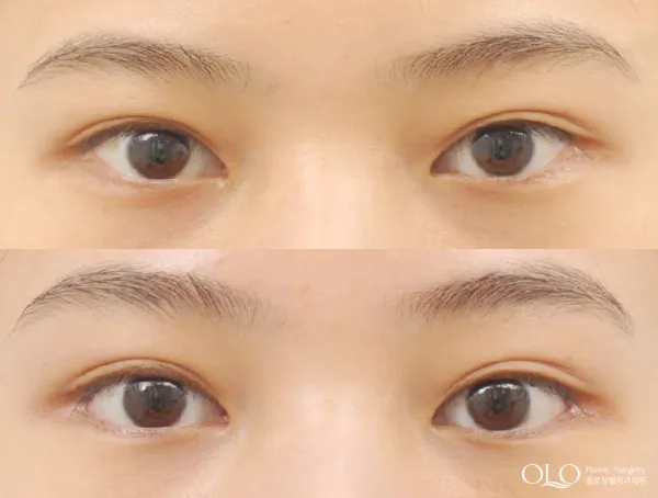 Before/After