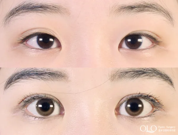 Before/After