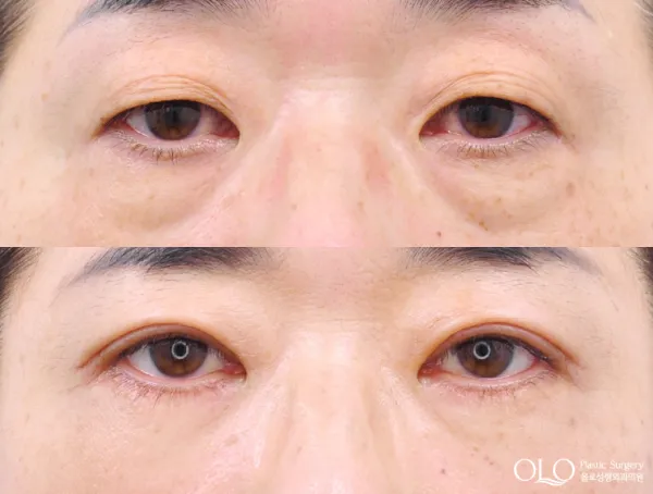 Before/After