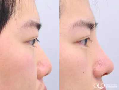 Before & After