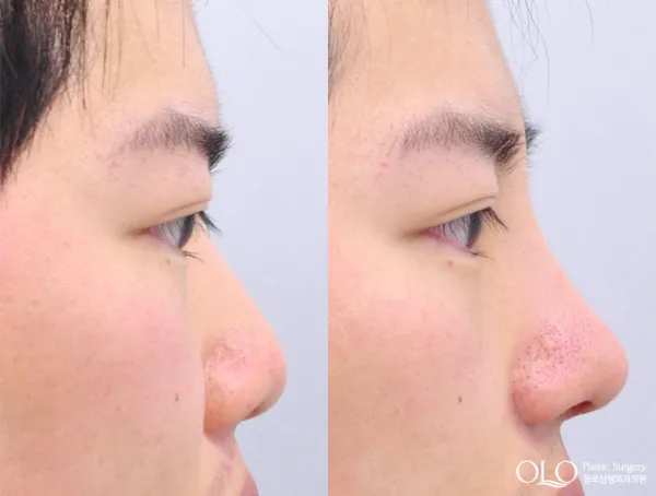 Before/After