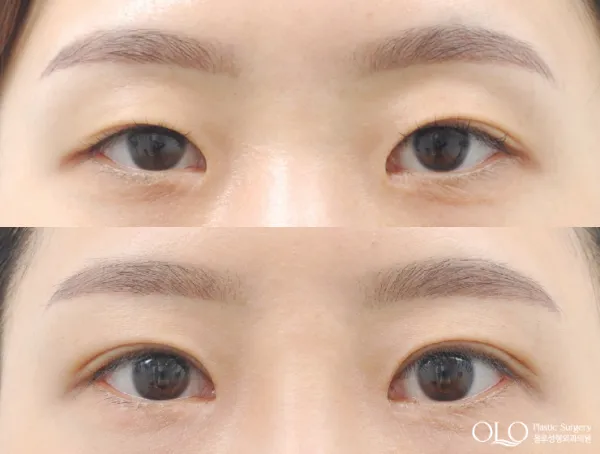 Before/After