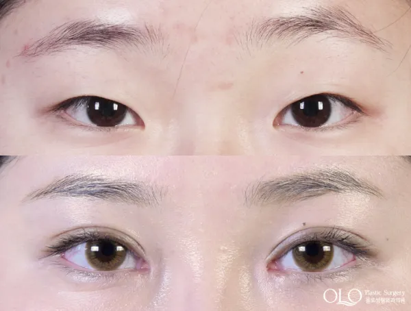 Before/After