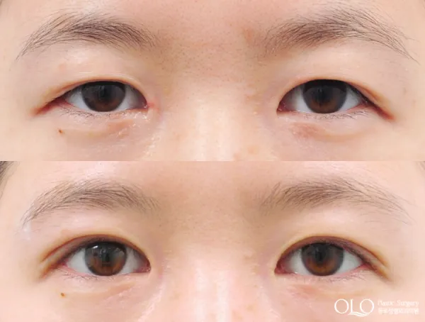 Before/After