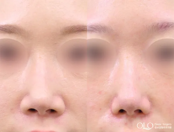 Before/After