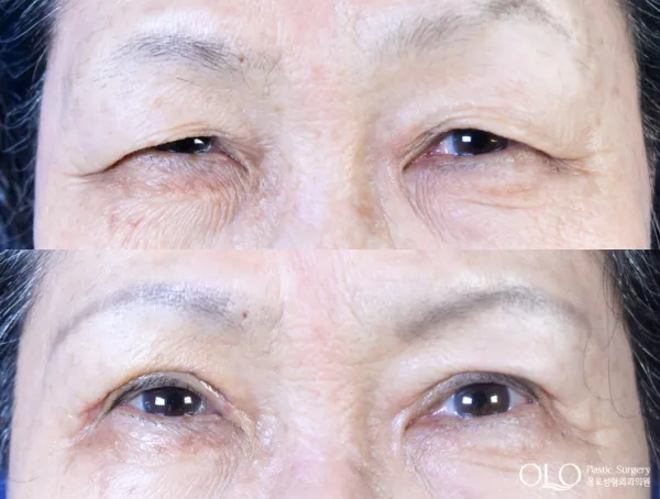 Before/After