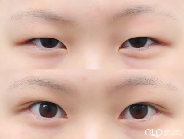 Before/After