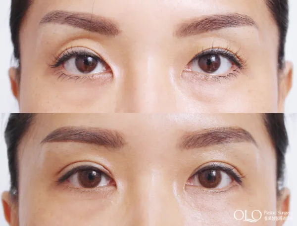 Before/After