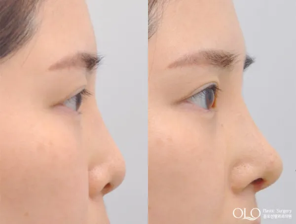 Before/After