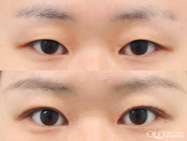 Before/After