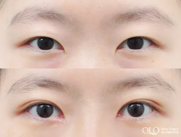 Before/After