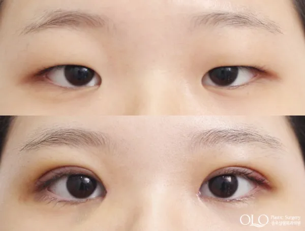 Before/After