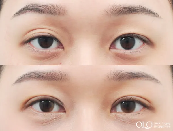 Before/After
