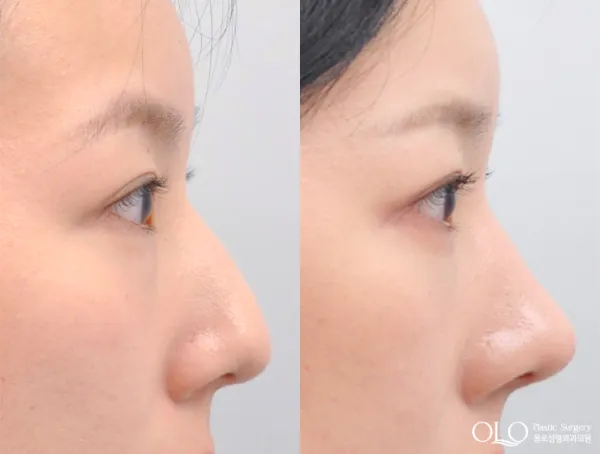 Before/After