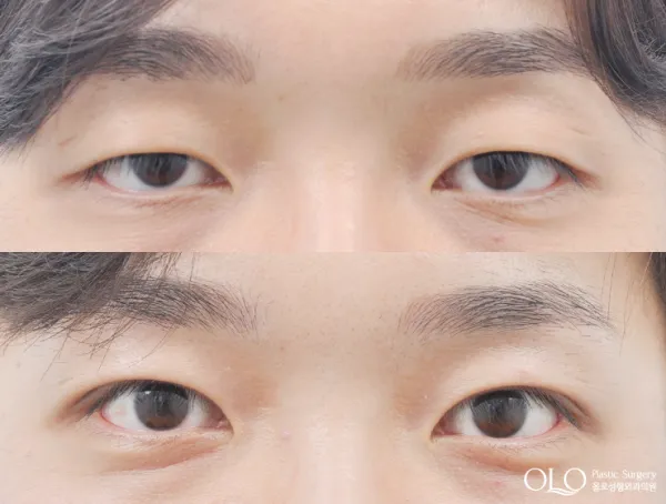 Before/After