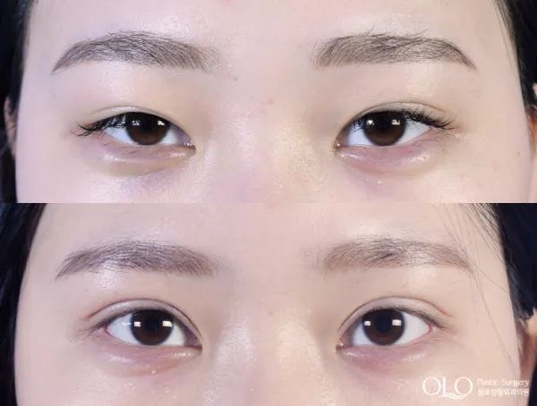 Before/After