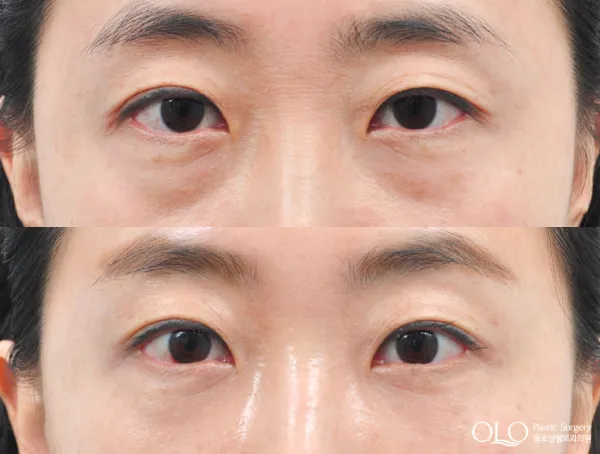 Before/After