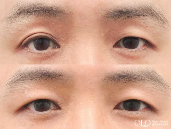 Before