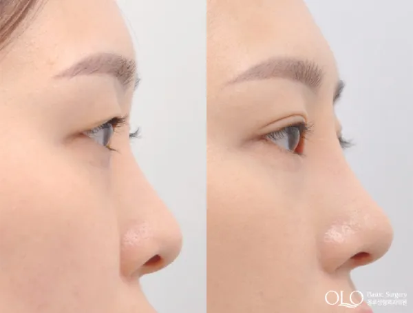 Before/After
