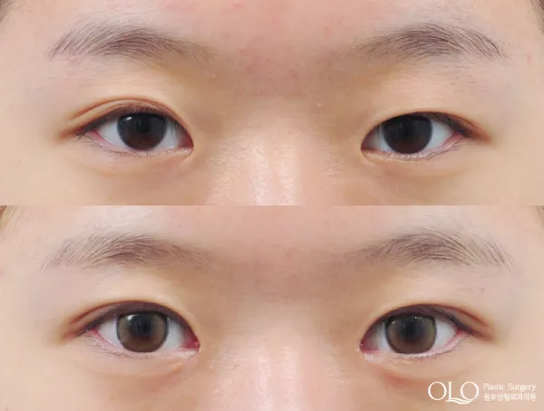 Before/After