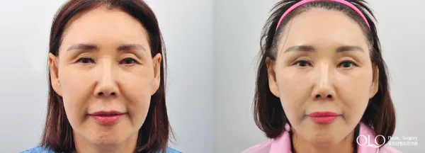 Before/After