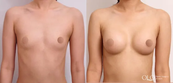 Before/After