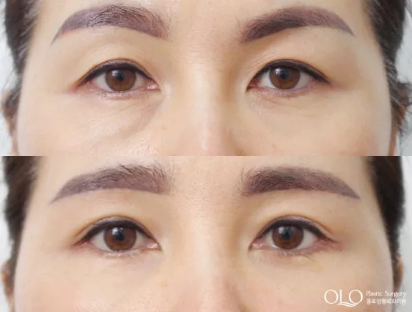 Before/After