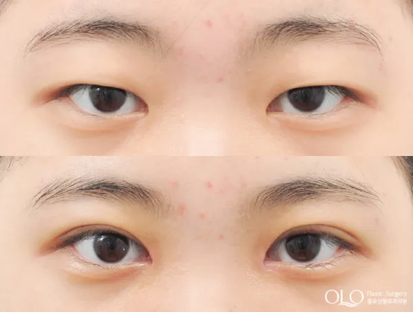 Before/After