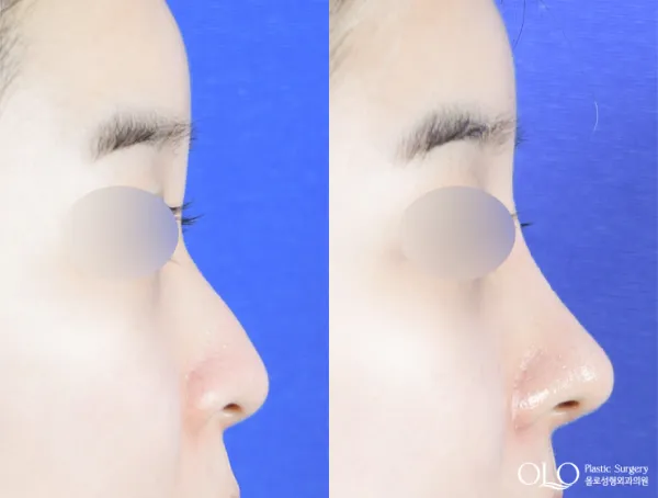 Before/After