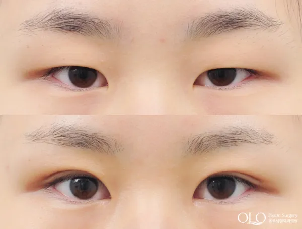 Before/After