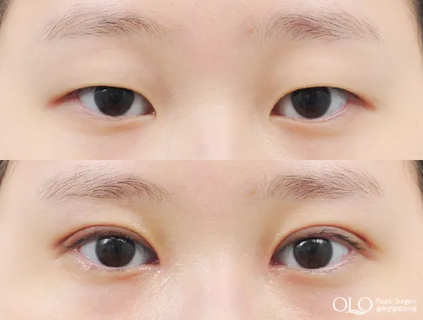 Before/After
