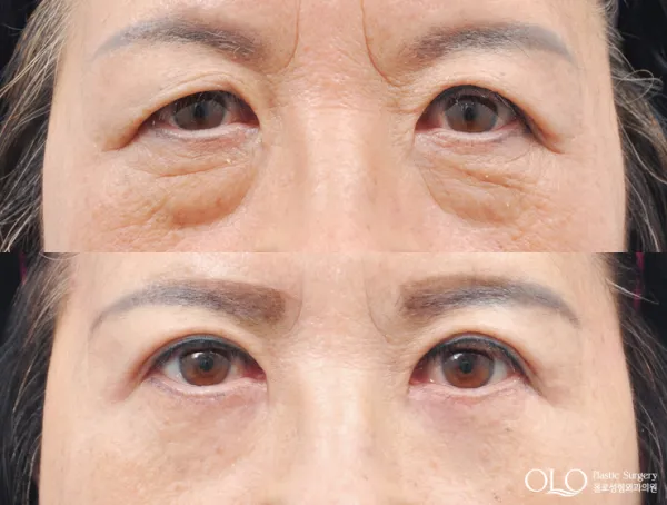Before/After