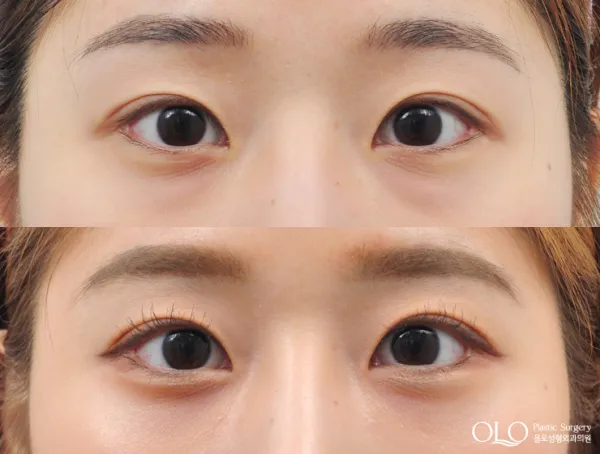 Before/After