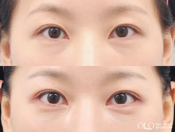 Before/After