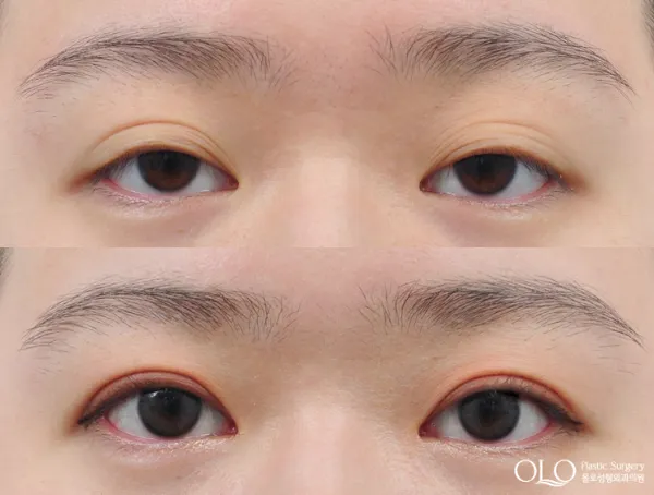 Before/After