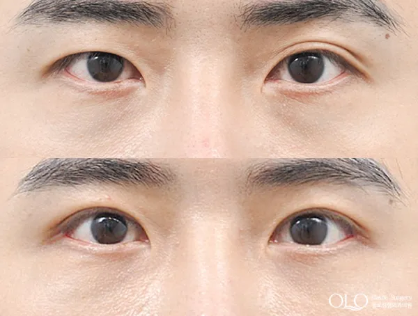 Before/After