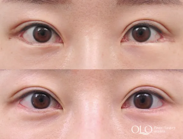 Before